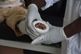 Zehen schauen aus einem Gips; zwei Hände in Handschuhen umfassen den eingegipsten Fuß
