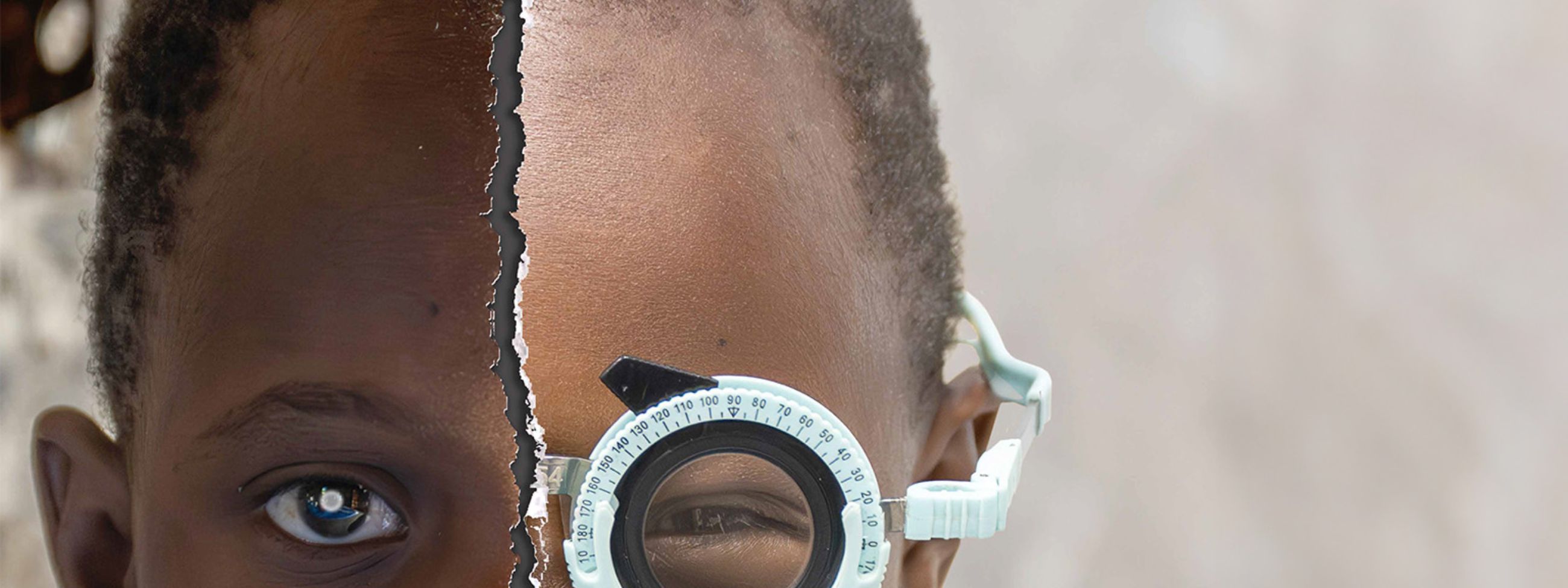Mädchen mit zwei Gesichtshälften: links mit hell leuchtender weißer Pupille, rechts mit einer Refraktionsbrille vor dem Auge.