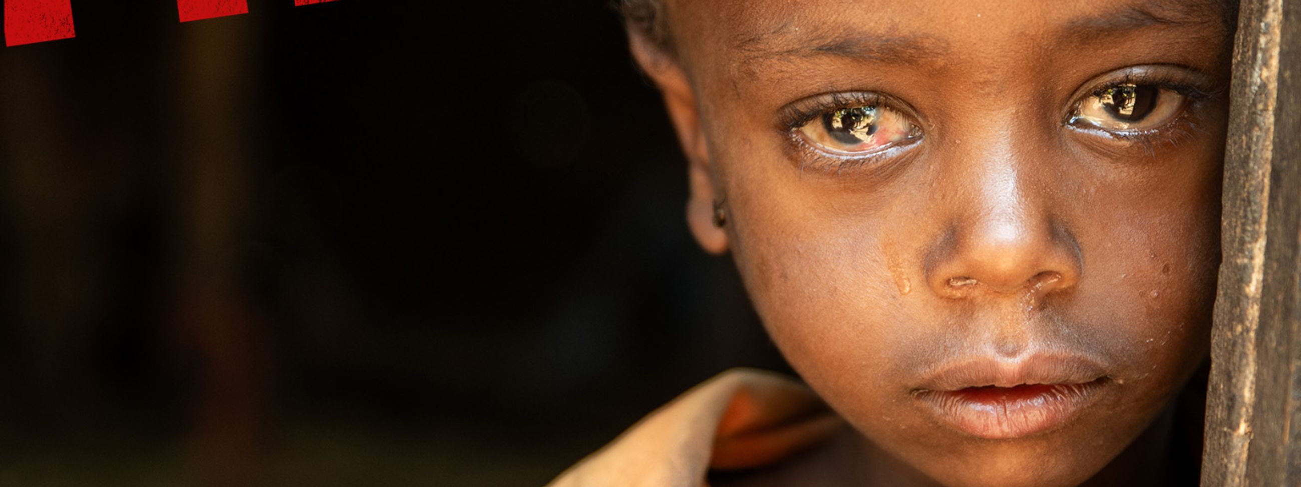 Kleiner Junge mit roten, entzündeten Augen