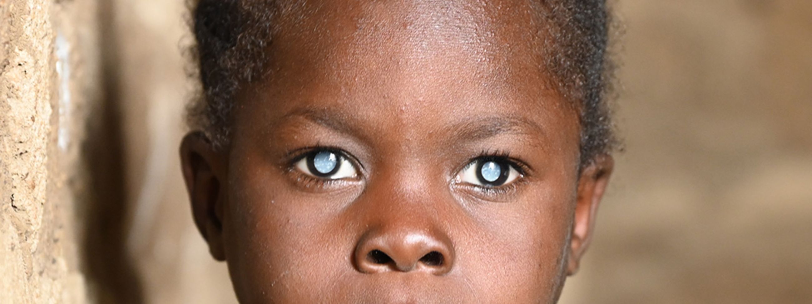 Ein etwa achtjähriges Mädchen im bunten Baumwollkleid mit weißen Pupillen in einem Raum mit gemauerten, unverputzten Wänden.