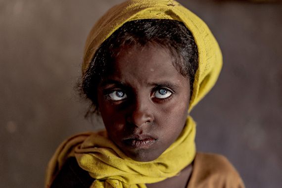 Ein etwa siebenjähriges Mädchen mit Kopftuch und auffallend weißen Pupillen.