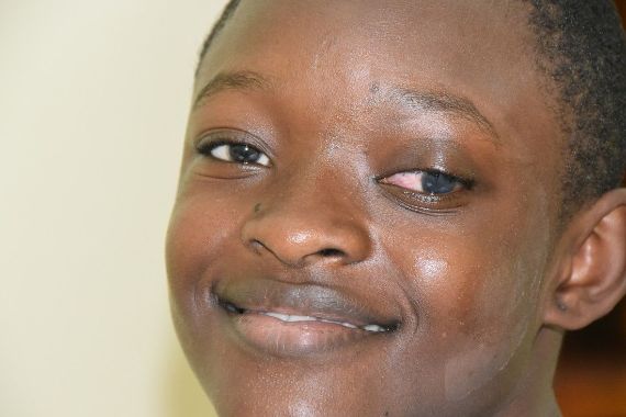 Afrikanisches Mädchen mit stark unterschiedlich großen Augen