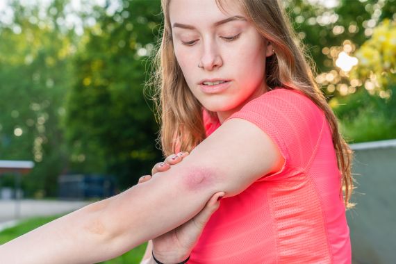 Junge Frau mit gerötetem Mückenstich am Arm.