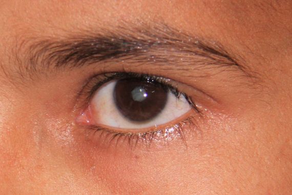 Thema Katarakt-Operation in Deutschland: Auge mit hell schimmernder Pupille