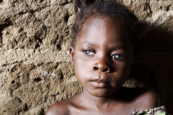 Ein kleines Mädchen mit weißen Pupillen sitzt an eine Mauer gelehnt.