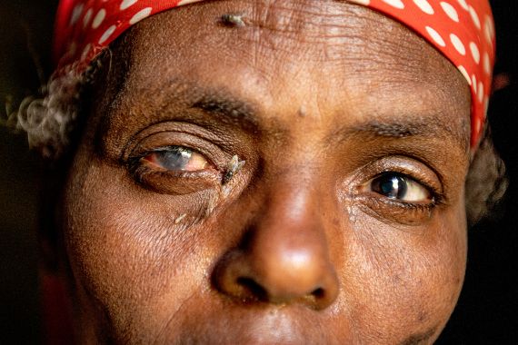 Mekiya aus Äthiopien hat Trachom. Fliegen sind ständig an ihren Augen auf der Suche nach Feuchtigkeit. Wegscheuchen hat keinen Zweck. 